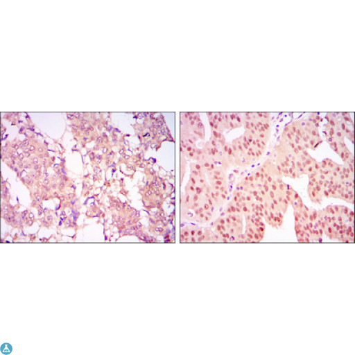 PRMT4 / CARM1 Antibody - Immunohistochemistry (IHC) analysis of paraffin-embedded breast cancer tissues (left) and ovarian cancer tissues (right) with DAB staining using PRMT4 Monoclonal Antibody.