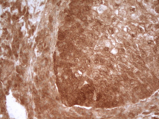 PRMT5 Antibody - Immunohistochemical staining of paraffin-embedded Carcinoma of Human lung tissue using anti-PRMT5 mouse monoclonal antibody. (Heat-induced epitope retrieval by 1 mM EDTA in 10mM Tris, pH8.5, 120C for 3min,