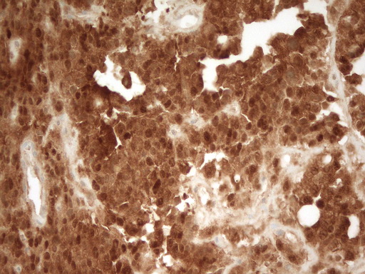 PRMT5 Antibody - Immunohistochemical staining of paraffin-embedded Human endometrium tissue within the normal limits using anti-PRMT5 mouse monoclonal antibody. (Heat-induced epitope retrieval by 1 mM EDTA in 10mM Tris, pH8.5, 120C for 3min,