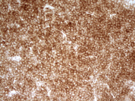 PRMT5 Antibody - Immunohistochemical staining of paraffin-embedded Human lymphoma tissue using anti-PRMT5 mouse monoclonal antibody. (Heat-induced epitope retrieval by 1 mM EDTA in 10mM Tris, pH8.5, 120C for 3min,