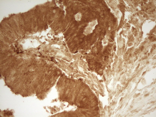 PRMT5 Antibody - Immunohistochemical staining of paraffin-embedded Human colon tissue within the normal limits using anti-PRMT5 mouse monoclonal antibody. (Heat-induced epitope retrieval by 1 mM EDTA in 10mM Tris, pH8.5, 120C for 3min,