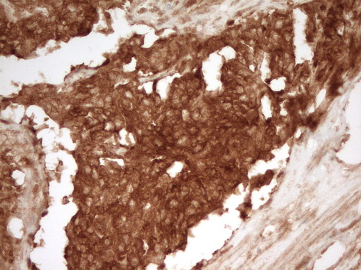 PRMT5 Antibody - IHC of paraffin-embedded Adenocarcinoma of Human endometrium tissue using anti-PRMT5 mouse monoclonal antibody. (Heat-induced epitope retrieval by 1 mM EDTA in 10mM Tris, pH8.5, 120°C for 3min).