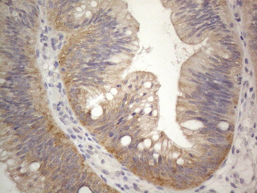 PRMT5 Antibody - Immunohistochemical staining of paraffin-embedded Carcinoma of Human pancreas tissue using anti-PRMT5 mouse monoclonal antibody. (Heat-induced epitope retrieval by 1mM EDTA in 10mM Tris buffer. (pH8.5) at 120°C for 3 min. (1:150)