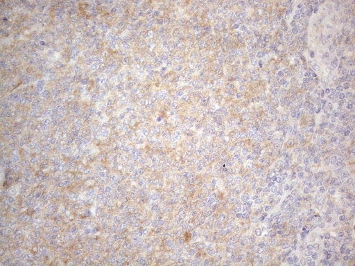 PRMT5 Antibody - Immunohistochemical staining of paraffin-embedded Human lymphoma tissue using anti-PRMT5 mouse monoclonal antibody. (Heat-induced epitope retrieval by 1mM EDTA in 10mM Tris buffer. (pH8.5) at 120°C for 3 min. (1:150)