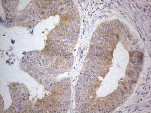 PRMT5 Antibody - Immunohistochemical staining of paraffin-embedded Adenocarcinoma of Human colon tissue using anti-PRMT5 mouse monoclonal antibody. (Heat-induced epitope retrieval by 1mM EDTA in 10mM Tris buffer. (pH8.5) at 120°C for 3 min. (1:150)