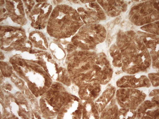 PRMT5 Antibody - Immunohistochemical staining of paraffin-embedded Human thyroid tissue within the normal limits using anti-PRMT5 mouse monoclonal antibody. (Heat-induced epitope retrieval by 1 mM EDTA in 10mM Tris, pH8.5, 120C for 3min,