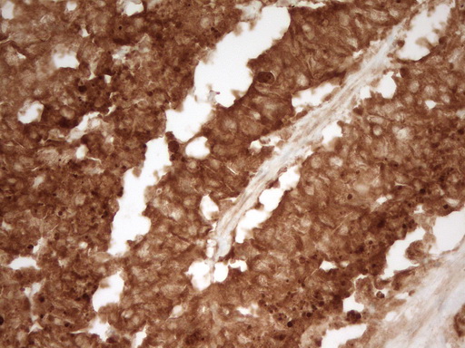 PRMT5 Antibody - Immunohistochemical staining of paraffin-embedded Adenocarcinoma of Human endometrium tissue using anti-PRMT5 mouse monoclonal antibody. (Heat-induced epitope retrieval by 1 mM EDTA in 10mM Tris, pH8.5, 120C for 3min,