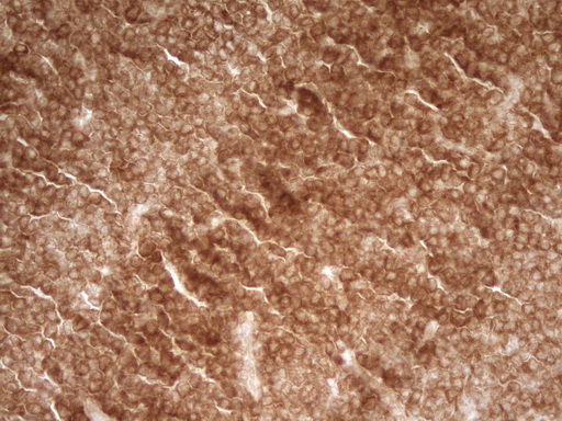 PRMT5 Antibody - Immunohistochemical staining of paraffin-embedded Human lymphoma tissue using anti-PRMT5 mouse monoclonal antibody. (Heat-induced epitope retrieval by 1 mM EDTA in 10mM Tris, pH8.5, 120C for 3min,