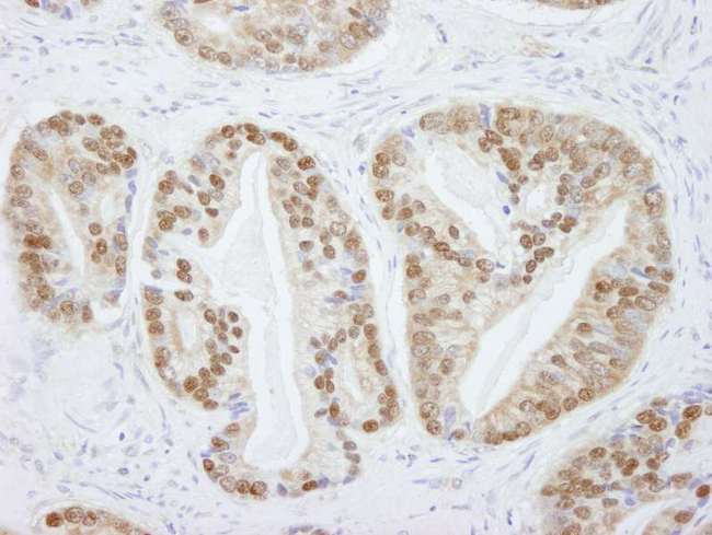 PRMT5 Antibody - Detection of Human PRMT5 by Immunohistochemistry. Sample: FFPE section of human prostate adenocarcinoma. Antibody: Affinity purified rabbit anti-PRMT5 used at a dilution of 1:250.