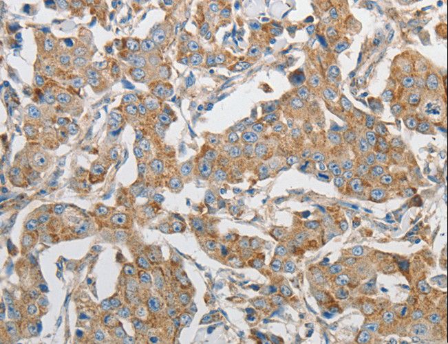 PRMT5 Antibody - Immunohistochemistry of paraffin-embedded Human breast cancer using PRMT5 Polyclonal Antibody at dilution of 1:20.