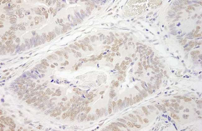 PRMT6 Antibody - Detection of Human PRMT6 by Immunohistochemistry. Sample: FFPE section of human colon carcinoma. Antibody: Affinity purified rabbit anti-PRMT6 used at a dilution of 1:250. Epitope Retrieval Buffer-High pH (IHC-101J) was substituted for Epitope Retrieval Buffer-Reduced pH.
