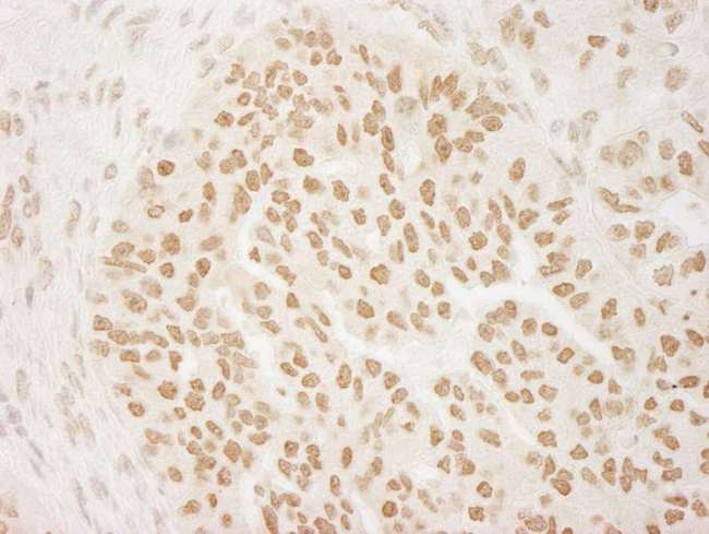 PRMT6 Antibody - Detection of Human PRMT6 by Immunohistochemistry. Sample: FFPE section of human breast carcinoma. Antibody: Affinity purified rabbit anti-PRMT6 used at a dilution of 1:5000 (0.2 ug/ml). Detection: DAB.