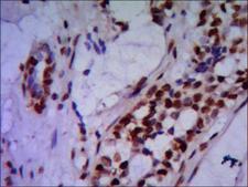 PRMT6 Antibody - Immunohistochemistry stain of paraffin-embedded human breast cancer using PRMT6 mouse monoclonal antibody (1:200).
