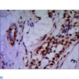 PRMT6 Antibody - Immunohistochemistry stain of paraffin-embedded human breast cancer using PRMT6 mouse mAb (1:200).