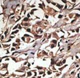 PRMT7 Antibody - Formalin-fixed and paraffin-embedded human cancer tissue reacted with the primary antibody, which was peroxidase-conjugated to the secondary antibody, followed by DAB staining. This data demonstrates the use of this antibody for immunohistochemistry; clinical relevance has not been evaluated. BC = breast carcinoma; HC = hepatocarcinoma.