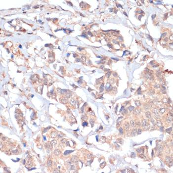 PRMT7 Antibody - Immunohistochemistry of paraffin-embedded Human breast cancer using PRMT7 Polyclonal Antibody at dilution of 1:200 (40x lens).