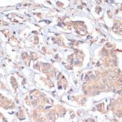 PRMT7 Antibody - Immunohistochemistry of paraffin-embedded Human breast cancer using PRMT7 Polyclonal Antibody at dilution of 1:200 (40x lens).
