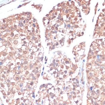 PRMT7 Antibody - Immunohistochemistry of paraffin-embedded Human gastric cancer using PRMT7 Polyclonal Antibody at dilution of 1:200 (40x lens).