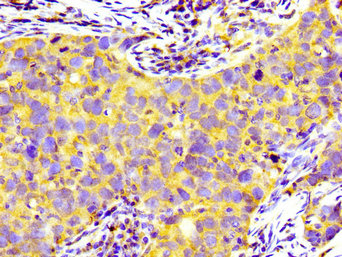 PRNP / PrP / Prion Antibody - Immunohistochemistry image of paraffin-embedded human pancreatic cancer at a dilution of 1:100