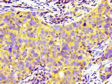 PRNP / PrP / Prion Antibody - Immunohistochemistry image of paraffin-embedded human pancreatic cancer at a dilution of 1:100