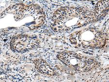 PRNP / PrP / Prion Antibody - Immunohistochemistry of paraffin-embedded Human cervical cancer tissue  using PRNP Polyclonal Antibody at dilution of 1:45(×200)