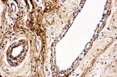 PROC / Protein C Antibody - PROC / Protein C antibody. IHC(P): Human Breast Cancer Tissue.
