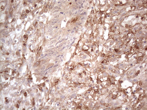 PROCR / EPCR Antibody - Immunohistochemical staining of paraffin-embedded Adenocarcinoma of Human colon tissue using anti-PROCR mouse monoclonal antibody. (Heat-induced epitope retrieval by 1mM EDTA in 10mM Tris buffer. (pH8.5) at 120°C for 3 min. (1:150)