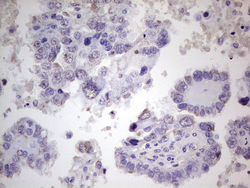 PROCR / EPCR Antibody - IHC of paraffin-embedded Adenocarcinoma of Human ovary tissue using anti-PROCR mouse monoclonal antibody. (Heat-induced epitope retrieval by 1 mM EDTA in 10mM Tris, pH8.5, 120°C for 3min).