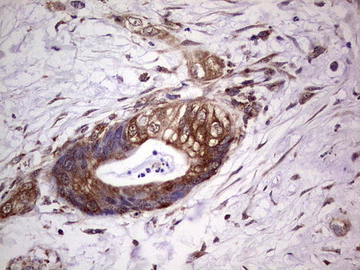 PROCR / EPCR Antibody - IHC of paraffin-embedded Carcinoma of Human pancreas tissue using anti-PROCR mouse monoclonal antibody. (Heat-induced epitope retrieval by 1 mM EDTA in 10mM Tris, pH8.5, 120°C for 3min).