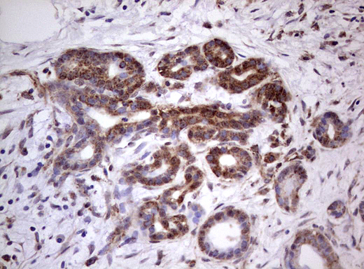 PROCR / EPCR Antibody - IHC of paraffin-embedded Carcinoma of Human pancreas tissue using anti-PROCR Mouse monoclonal antibody. (heat-induced epitope retrieval by 1 mM EDTA in 10mM Tris, pH8.5, 120°C for 3min).