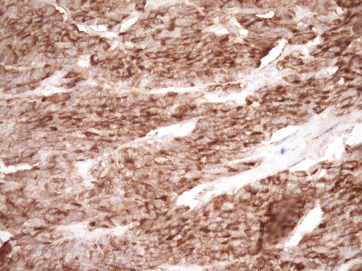 PROCR / EPCR Antibody - Immunohistochemical staining of paraffin-embedded Carcinoma of Human lung tissue using anti-PROCR mouse monoclonal antibody. (Heat-induced epitope retrieval by 1 mM EDTA in 10mM Tris, pH8.5, 120C for 3min,