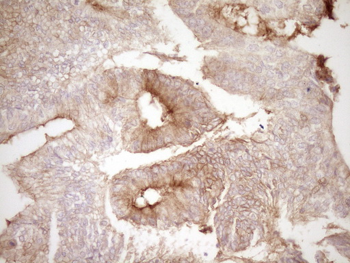 PROCR / EPCR Antibody - Immunohistochemical staining of paraffin-embedded Adenocarcinoma of Human colon tissue using anti-PROCR mouse monoclonal antibody. (Heat-induced epitope retrieval by 1 mM EDTA in 10mM Tris, pH8.5, 120C for 3min,