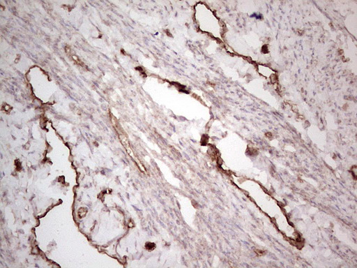 PROCR / EPCR Antibody - IHC of paraffin-embedded Adenocarcinoma of Human endometrium tissue using anti-PROCR mouse monoclonal antibody. (Heat-induced epitope retrieval by 1 mM EDTA in 10mM Tris, pH8.5, 120°C for 3min).