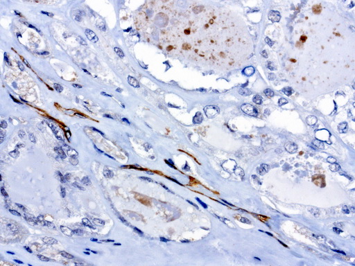 PROCR / EPCR Antibody - Immunohistochemical staining of paraffin-embedded human thyroid cancer using anti-PROCR clone UMAB200 mouse monoclonal antibody  at 1:100 with Polink2 Broad HRP DAB detection kit; heat-induced epitope retrieval with GBI citrate pH6.0 HIER buffer using pressure chamber for 3 minutes at 110C. Cytoplasmic staining is very strong in the vascular endothelia cells no staining in tumor cells.