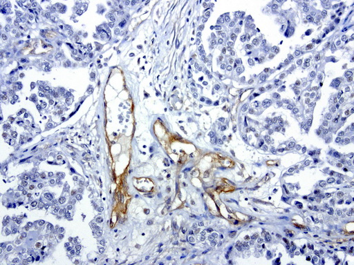 PROCR / EPCR Antibody - Immunohistochemical staining of paraffin-embedded human ovarian cancer using anti-PROCR clone UMAB200 mouse monoclonal antibody  at 1:100 with Polink2 Broad HRP DAB detection kit; heat-induced epitope retrieval with GBI citrate pH6.0 HIER buffer using pressure chamber for 3 minutes at 110C. Cytoplasmic staining is very strong in the vascular endothelia cells and weak nuclear staining in ovarian tumor cells.