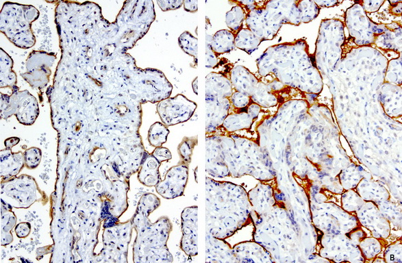 PROCR / EPCR Antibody - Immunohistochemical staining of 2 cases of paraffin-embedded human placenta using anti-PROCR clone UMAB200 mouse monoclonal antibody  at 1:100 with Polink2 Broad HRP DAB detection kit; heat-induced epitope retrieval with GBI citrate pH6.0 HIER buffer using pressure chamber for 3 minutes at 110C. Very strong membraneous staining in the trophoblast cells. The endothelial cells show both cytoplasmic and membraneous staining.
