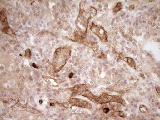 PROCR / EPCR Antibody - Immunohistochemical staining of paraffin-embedded Carcinoma of Human lung tissue using anti-PROCR mouse monoclonal antibody. (Heat-induced epitope retrieval by 1mM EDTA in 10mM Tris buffer. (pH8.0) at 120C for 3 min. (1:200)