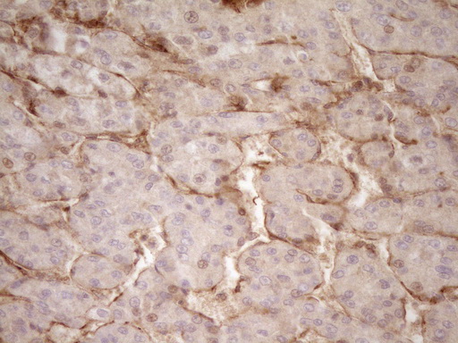 PROCR / EPCR Antibody - Immunohistochemical staining of paraffin-embedded Carcinoma of Human liver tissue using anti-PROCR mouse monoclonal antibody. (Heat-induced epitope retrieval by 1mM EDTA in 10mM Tris buffer. (pH8.0) at 120C for 3 min. (1:200)