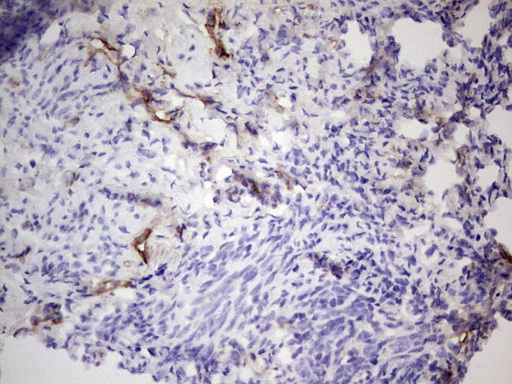 PROCR / EPCR Antibody - Immunohistochemical staining of paraffin-embedded Adenocarcinoma of Human endometrium tissue using anti-PROCR mouse monoclonal antibody. (Heat-induced epitope retrieval by 1 mM EDTA in 10mM Tris, pH8.5, 120C for 3min,