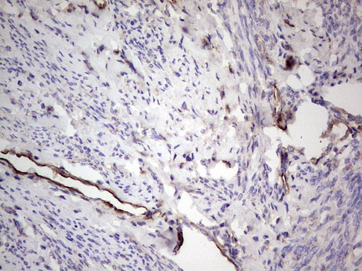 PROCR / EPCR Antibody - Immunohistochemical staining of paraffin-embedded Adenocarcinoma of Human endometrium tissue using anti-PROCR mouse monoclonal antibody. (Heat-induced epitope retrieval by 1 mM EDTA in 10mM Tris, pH8.5, 120C for 3min,