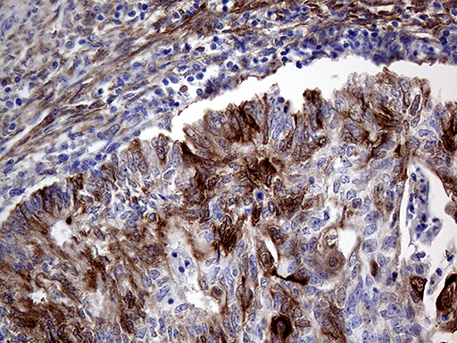 PRODH Antibody - Immunohistochemical staining of paraffin-embedded Adenocarcinoma of Human endometrium tissue using anti-PRODH mouse monoclonal antibody. (Heat-induced epitope retrieval by 1mM EDTA in 10mM Tris buffer. (pH8.5) at 120°C for 3 min. (1:500)