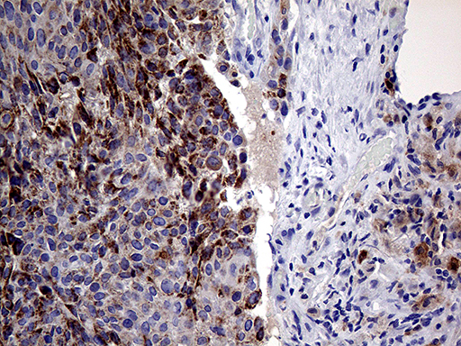 PRODH Antibody - Immunohistochemical staining of paraffin-embedded Carcinoma of Human bladder tissue using anti-PRODH mouse monoclonal antibody. (Heat-induced epitope retrieval by 1mM EDTA in 10mM Tris buffer. (pH8.5) at 120°C for 3 min. (1:500)
