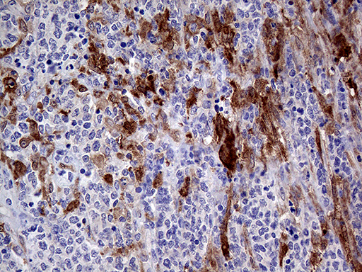 PRODH Antibody - Immunohistochemical staining of paraffin-embedded Human lymphoma tissue using anti-PRODH mouse monoclonal antibody. (Heat-induced epitope retrieval by 1mM EDTA in 10mM Tris buffer. (pH8.5) at 120°C for 3 min. (1:500)
