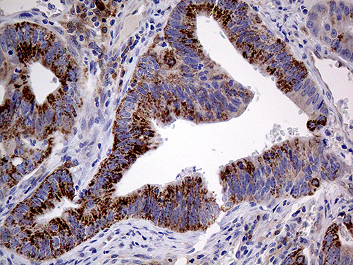 PRODH Antibody - Immunohistochemical staining of paraffin-embedded Adenocarcinoma of Human colon tissue using anti-PRODH mouse monoclonal antibody. (Heat-induced epitope retrieval by 1mM EDTA in 10mM Tris buffer. (pH8.5) at 120°C for 3 min. (1:500)