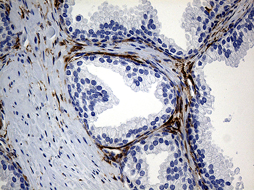 PRODH Antibody - Immunohistochemical staining of paraffin-embedded Carcinoma of Human prostate tissue using anti-PRODH mouse monoclonal antibody. (Heat-induced epitope retrieval by 1mM EDTA in 10mM Tris buffer. (pH8.5) at 120°C for 3 min. (1:500)