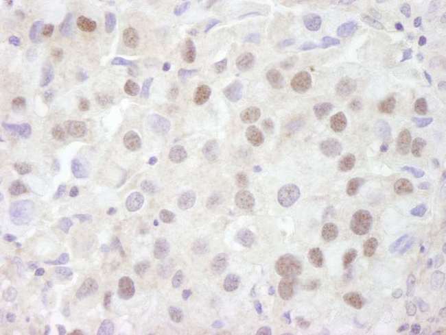 Prohibitin 2 / PHB2 Antibody - Detection of Human REA by Immunohistochemistry. Sample: FFPE section of human breast adenocarcinoma. Antibody: Affinity purified rabbit anti-REA used at a dilution of 1:250. Detection: DAB.