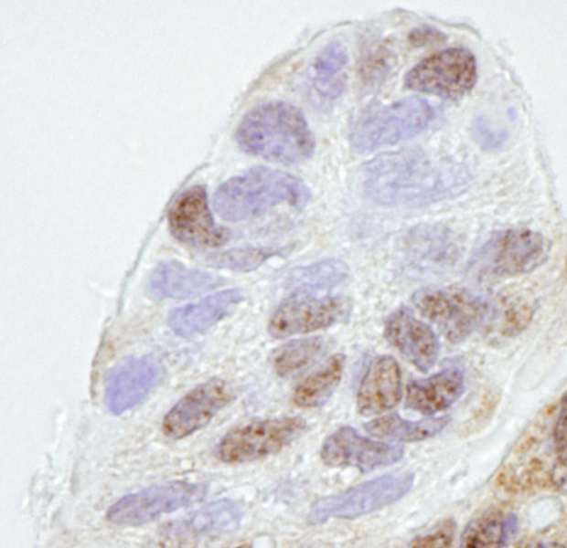 Prohibitin 2 / PHB2 Antibody - Detection of Human REA by Immunohistochemistry. Sample: FFPE section of human ovarian carcinoma. Antibody: Affinity purified rabbit anti-REA used at a dilution of 1:250. Detection: DAB.