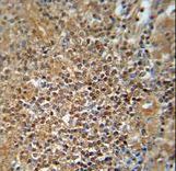 Prohibitin 2 / PHB2 Antibody - PHB2 Antibody (Y248)immunohistochemistry of formalin-fixed and paraffin-embedded human prostate carcinoma followed by peroxidase-conjugated secondary antibody and DAB staining.
