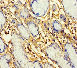PROKR1 Antibody - Immunohistochemistry of paraffin-embedded human gastric cancer using PROKR1 Antibody at dilution of 1:100