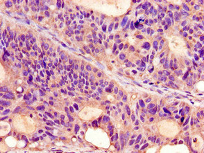 PROKR2/Prokineticin Receptor 2 Antibody - Immunohistochemistry image of paraffin-embedded human colon cancer at a dilution of 1:100